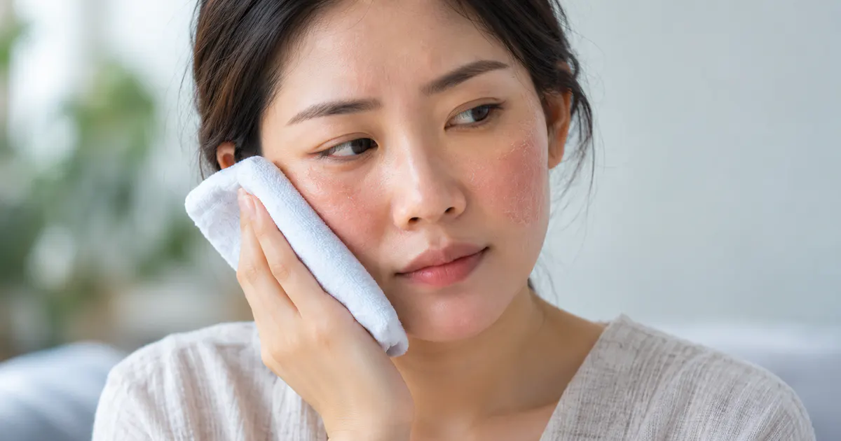 Người bệnh chườm khăn mát nhẹ để giảm ngứa trên vùng mặt