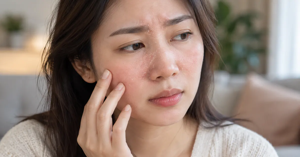 Cận cảnh người phụ nữ chăm sóc vùng da có viêm da dầu ở mặt một cách nhẹ nhàng
