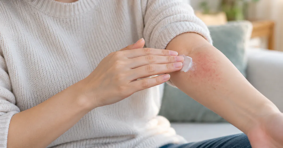 Chăm sóc vùng da khô kích ứng để giảm khó chịu do viêm da dị ứng