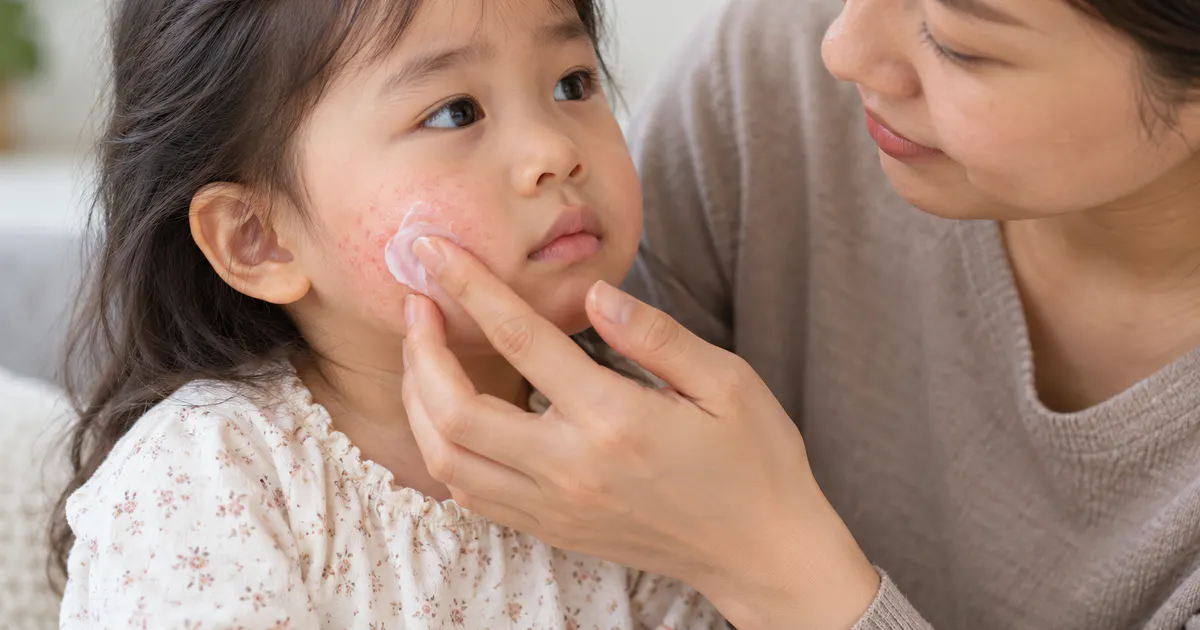 Cha mẹ chăm sóc làn da của trẻ bị viêm da dị ứng ở trẻ em