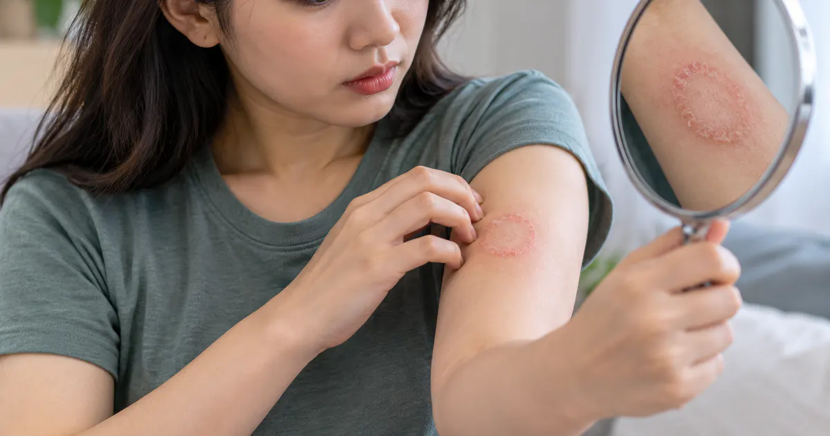 Minh họa người bệnh quan sát vùng da đỏ ngứa để nhận biết dấu hiệu nấm