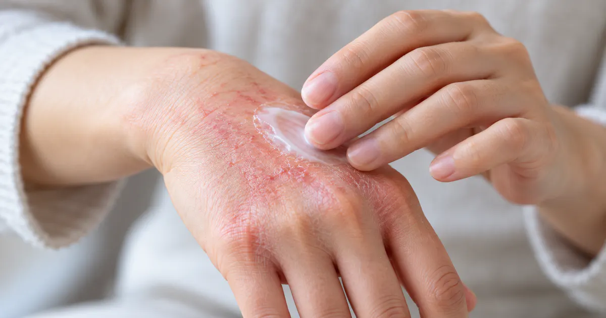 Cận cảnh bàn tay bị viêm da kích ứng đang được chăm sóc nhẹ nhàng