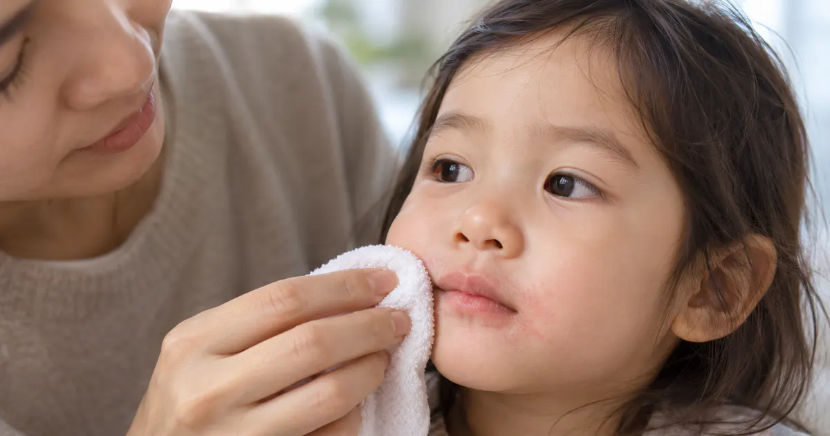 Bé được cha mẹ chăm sóc nhẹ nhàng vùng da bị viêm da quanh miệng ở trẻ em