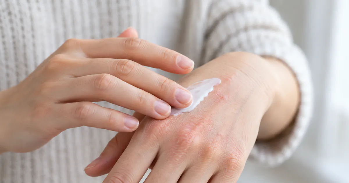 Cận cảnh bàn tay có biểu hiện viêm da tay khô đỏ được chăm sóc nhẹ nhàng