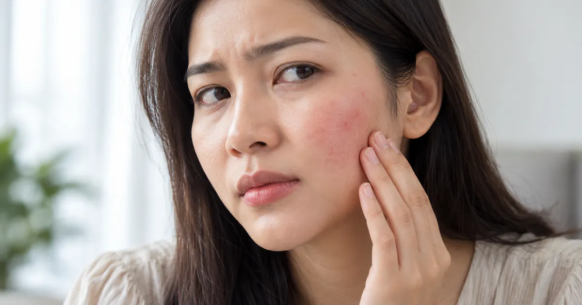Người phụ nữ chăm sóc vùng da mặt đang đỏ ngứa do viêm da tiếp xúc dị ứng ở mặt