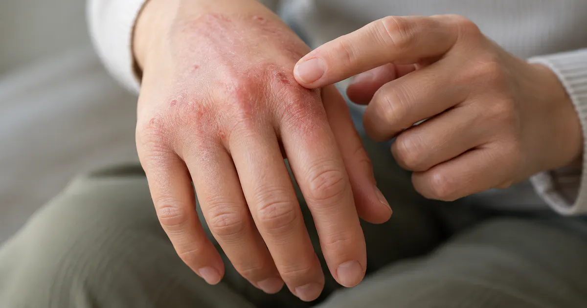 Cận cảnh bàn tay có vùng đỏ cần được nhân viên y tế đánh giá