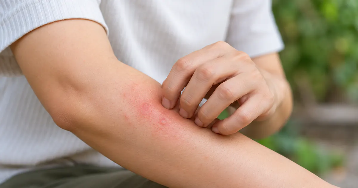Cận cảnh vùng da bị viêm da tiếp xúc do côn trùng được chăm sóc nhẹ nhàng