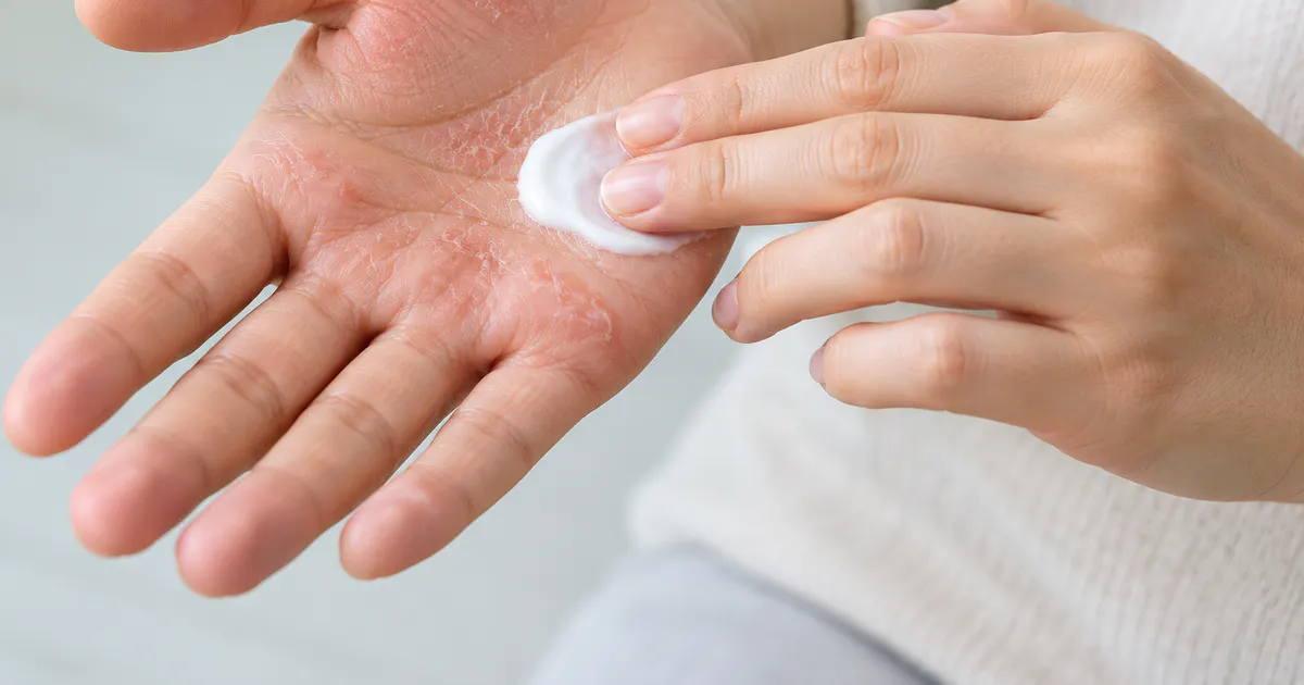Minh họa bàn tay được dưỡng ẩm nhẹ nhàng khi chăm sóc viêm da tổ đỉa ở tay