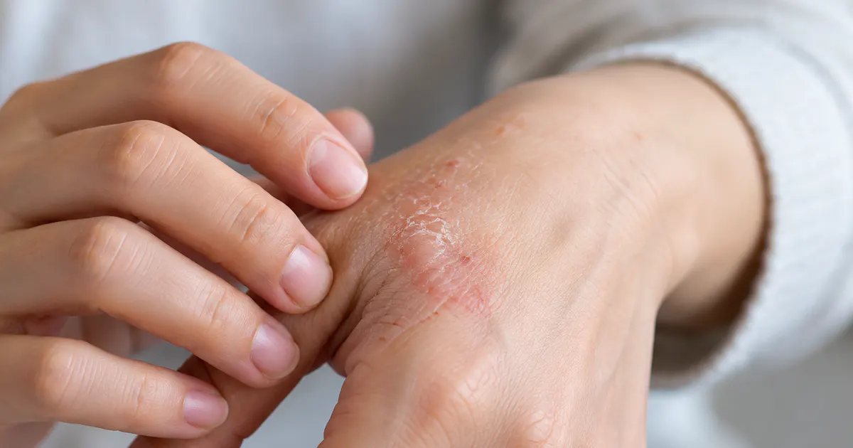 Bàn tay có vùng da nứt nhẹ cần theo dõi dấu hiệu nhiễm trùng