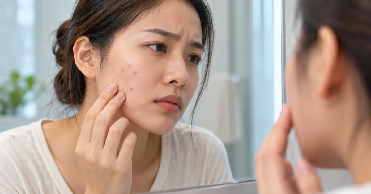 Cận cảnh người chăm sóc vùng da bị viêm nang lông ở mặt một cách nhẹ nhàng