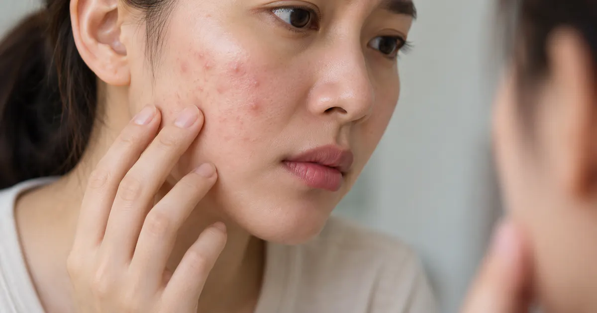 Theo dõi dấu hiệu nặng của viêm nang lông ở mặt để đi khám