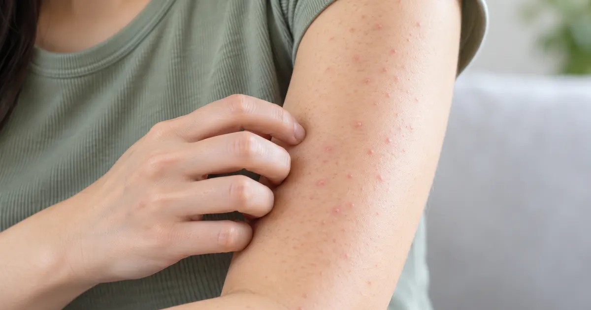 Cận cảnh cánh tay có các nốt đỏ nhẹ do viêm nang lông ở tay